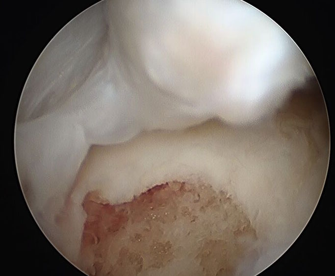 Mensical Root Repair Drill Hole